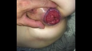 Anal dildo prolapso esguicho bunda grande